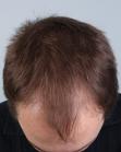 Before Hair Transplant&nbsp;Front